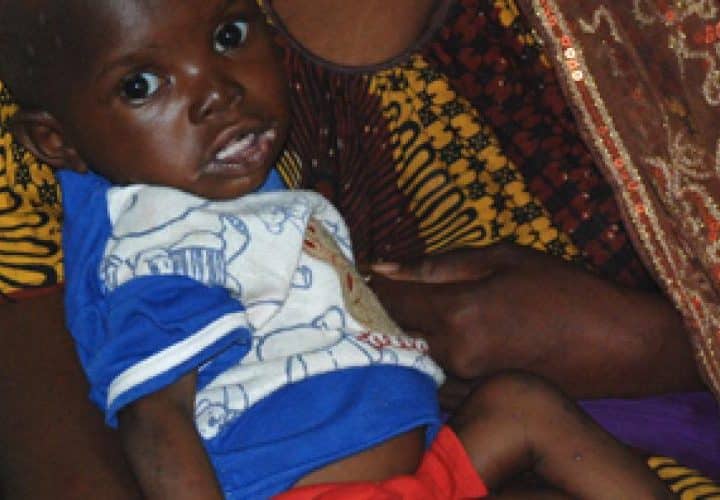 Young child receiving nutritional support at a health center in Mali